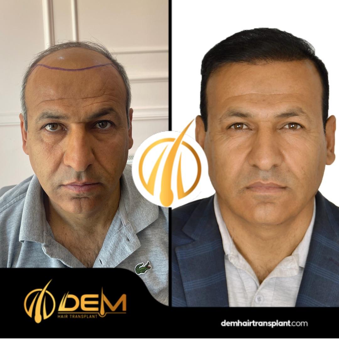 DEM sonuç 10