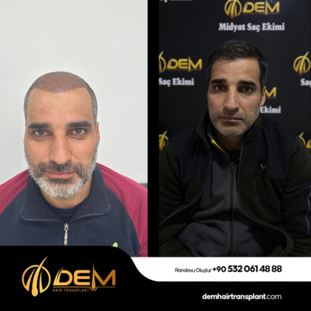 DEM sonuç 20